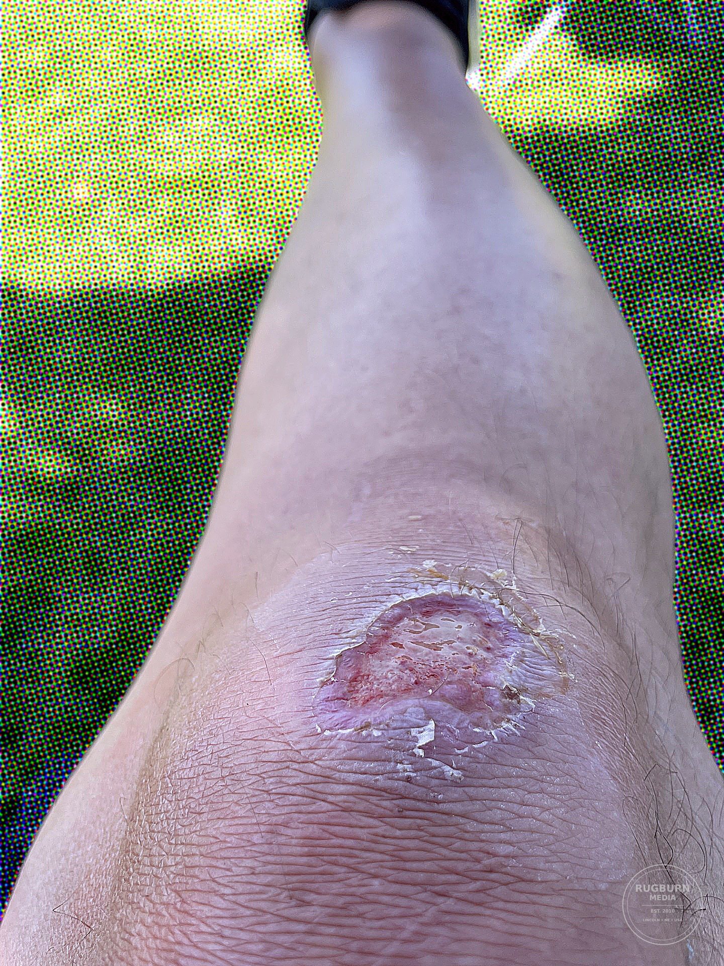 The original Rugburn idea represented by a skinned knee